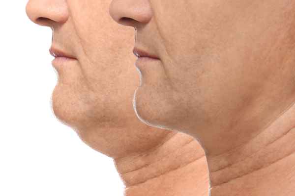 HIFU - Breakthrough in Anti - ageing 2 hifu results Earl Shilton