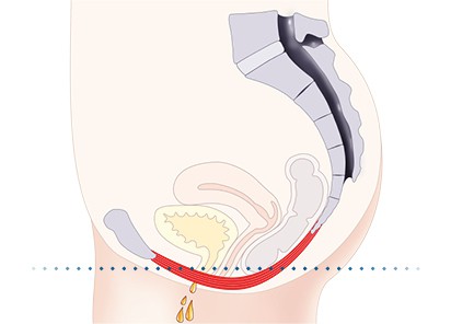 Pelvic-Floor Muscle Repair 5 Pelvic floor muscles Earl Shilton