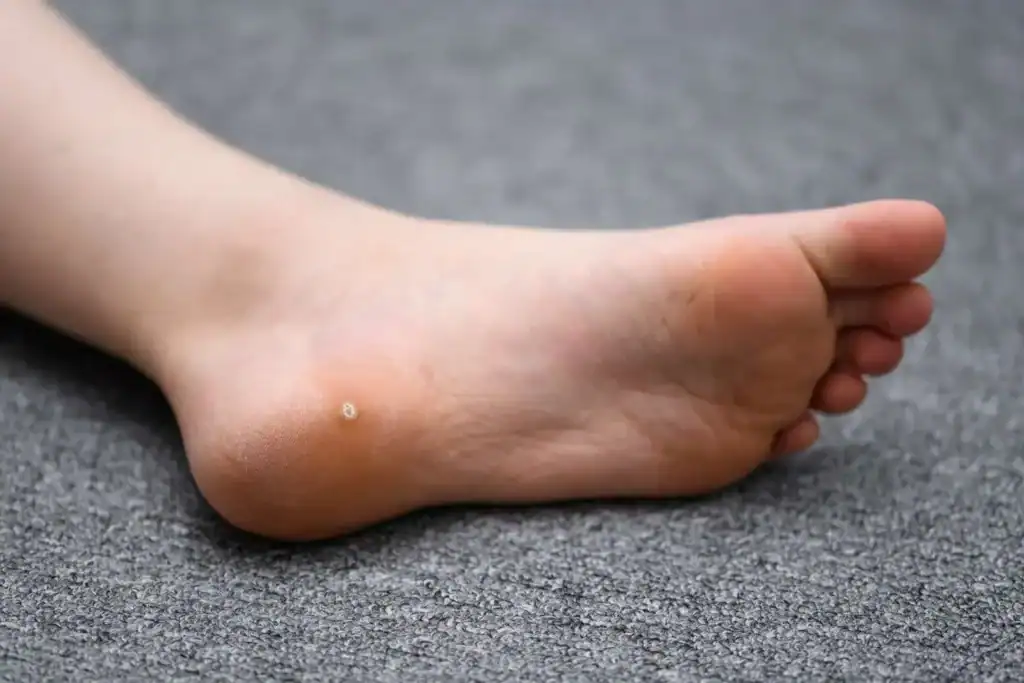 Cryotherapy For Warts And Also Verrucas 2 Image of verruca on the bottom of the foot that able to be treated with Cryotherapy Earl Shilton
