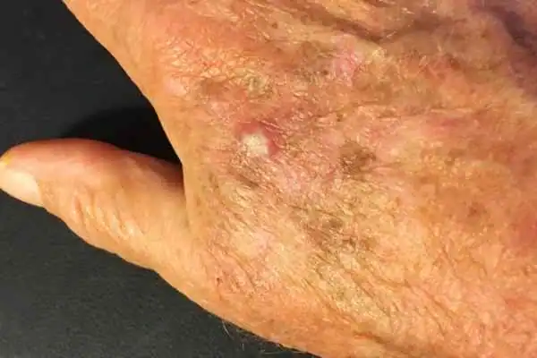 CryoPen for Actinic Keratoses 1 Image of Actinic keratoses Earl Shilton on a person hand