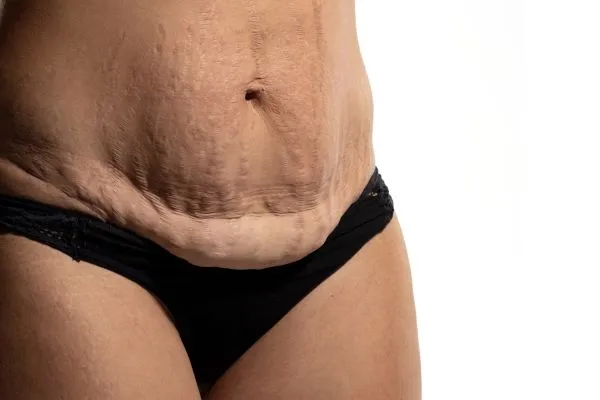 The science behind skin tightening Earl Shilton picture of a woman's sagging skin on the stomach